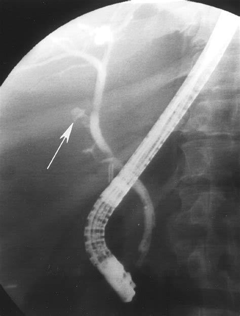 Bile Duct Leaks 